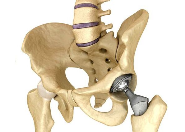 Hip endoprothetic