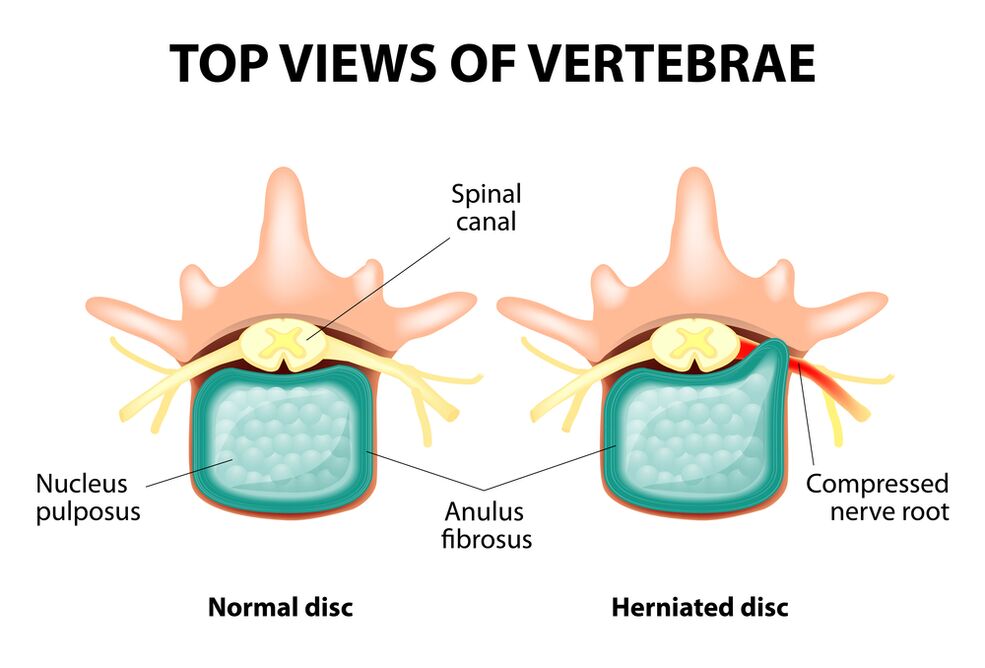 Healthy intervertebral discs and hernia