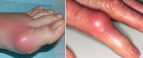 appearance of arthritic joints