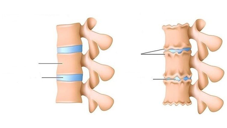 a healthy spine and a spine affected by osteochondrosis
