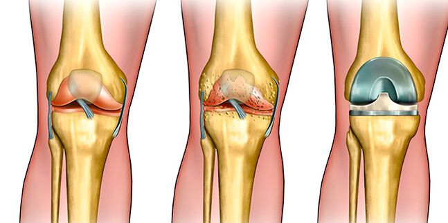 In the third stage of arthrosis, knee replacement is necessary