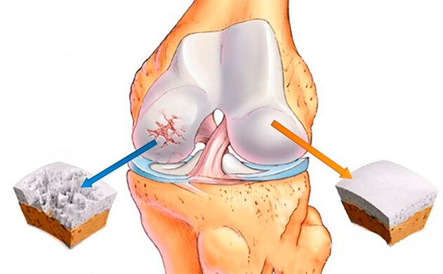 Normal knee joint (right) and affected by osteoarthritis (left)