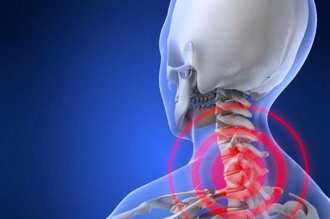 Shooting pain in the neck - an early symptom of cervical osteochondrosis