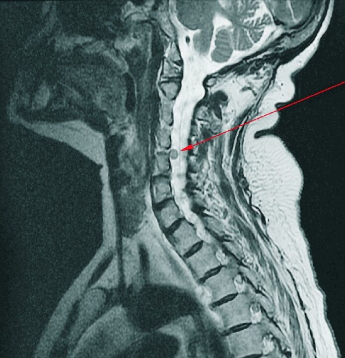 Intervertebral hernia of the cervical vertebrae on MRI