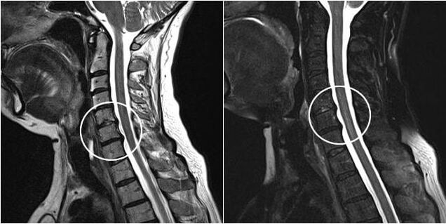 MRI of the cervical vertebrae with signs of osteochondrosis