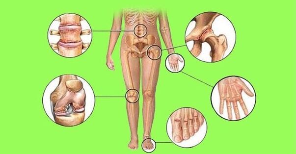 joints affected by arthritis and arthrosis