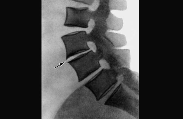 Manifestations of osteochondrosis of the chest on the X-ray