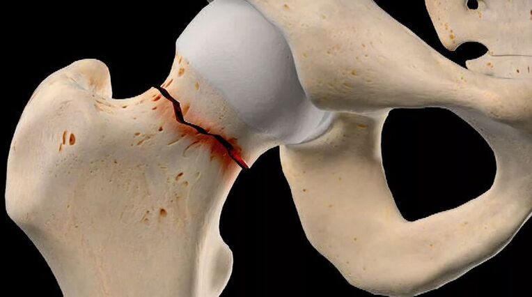 Fracture of the neck of the femur is one of the causes of secondary coxarthrosis. 