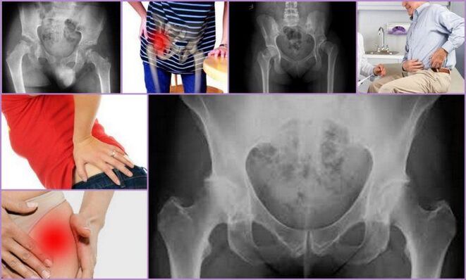 Pain and limited mobility are the main symptoms of osteoarthritis of the hip