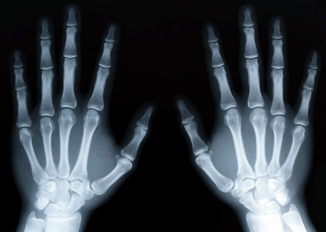 Gout provokes the development of gouty arthritis, which can be diagnosed with the help of X-rays